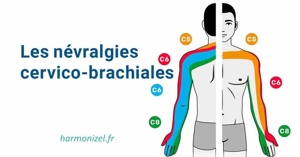Zones touchées par la névralgie cervico-brachiale selon le nerf cervical concerné